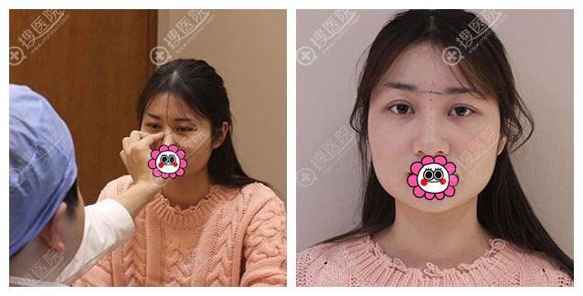 到常德伊丽莎白做双眼皮隆鼻前 到常德伊丽莎白做双眼皮隆鼻前