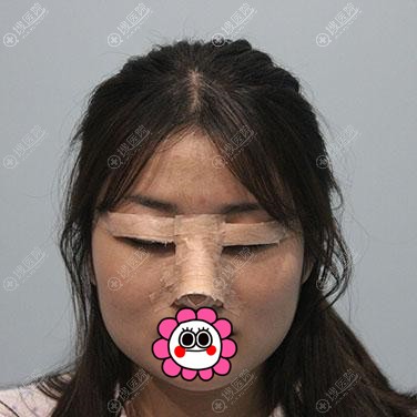 做双眼皮和隆鼻术后有点丑 做双眼皮和隆鼻术后有点丑