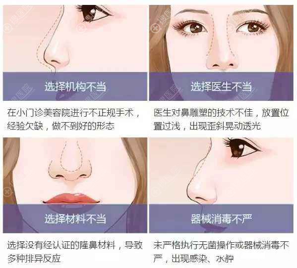 导致隆鼻失败的原因 导致隆鼻失败的原因