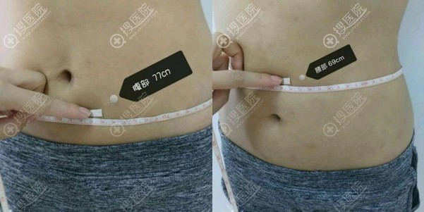 运动减肥不管用后找贵阳美贝尔李观龙做腰腹吸脂还真减肥成功了