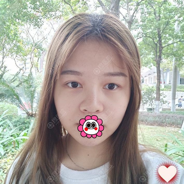 我找兰州梦想赵梅霞做耳软骨隆鼻恢复三个月变化还是挺大的