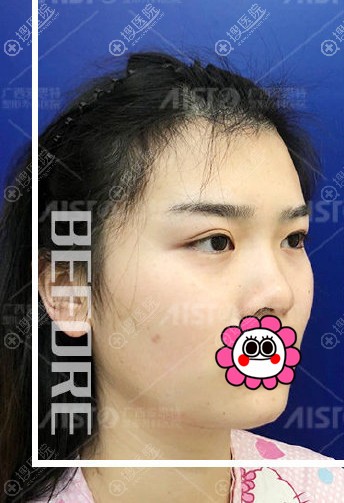 想改善面部轮廓不如到广西爱思特找李俊明做面部脂肪填充试试