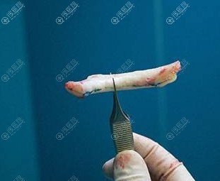肋软骨隆鼻全肋半肋有什么区别? 肋软骨隆鼻全肋半肋有什么区别?
