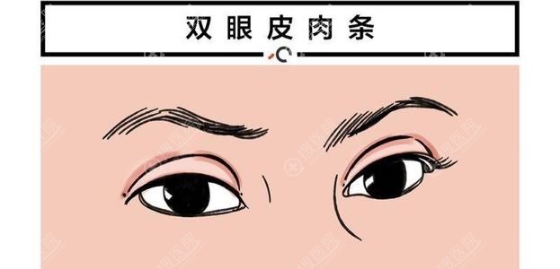 双眼皮出现肉条的原因? 双眼皮出现肉条的原因?