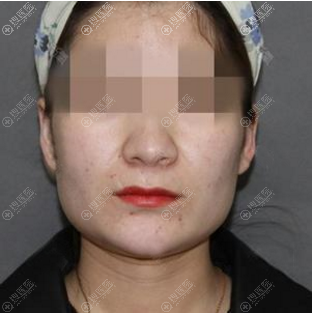 北京圣嘉新张笑天磨骨多少钱?我找他做下颌角手术费用是4万多元