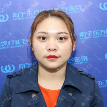 这次找南宁东方整形龙海波做的肋软骨隆鼻效果简直美得不像话
