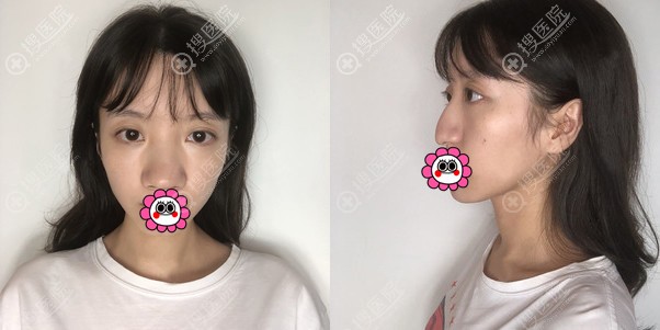 听说贵阳利美康童大潮做隆鼻恢复快,恢复到一个月的时候我信了