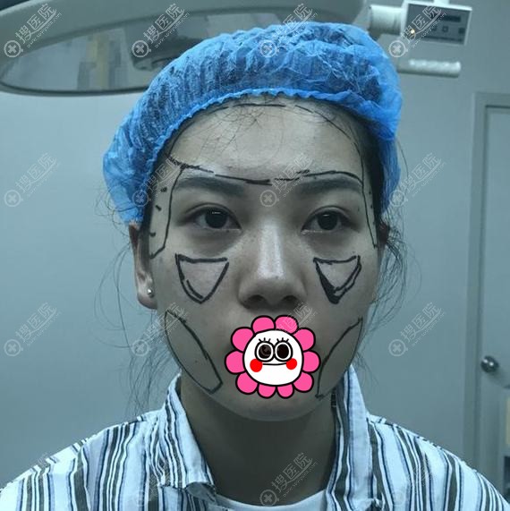 在厦门华美做完自体脂肪填充额头担心吸收太多恢复后效果挺满意