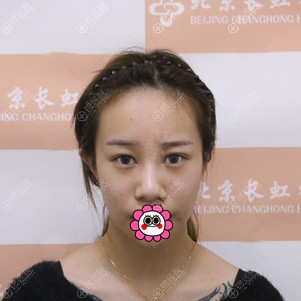 听到用自体肋软骨隆鼻会觉着不安全可我在北京画美做的效果不错