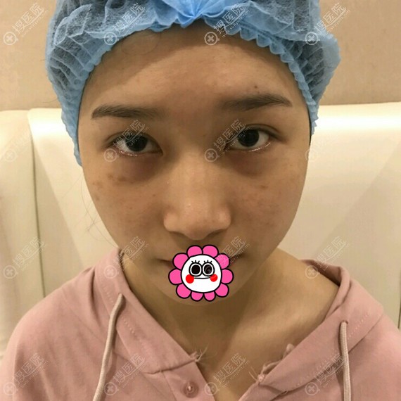 说说我在乐山达芬奇找陈科做鼻头缩小亲身经历很佩服自己的勇气