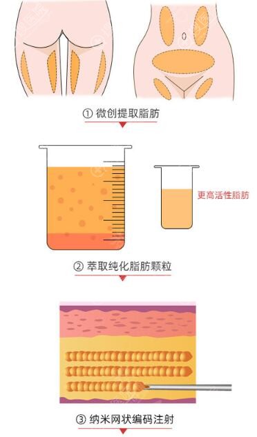 北京润美玉之光脂肪填充技术 北京润美玉之光脂肪填充技术