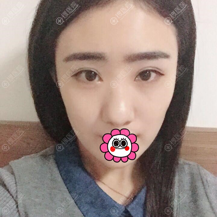大连爱德丽格有位叫何明达的医生做假体隆鼻技术好审美也好