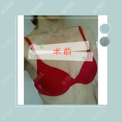 在韩国MD医院做的魔滴假体隆胸280/295cc恢复后达到了C杯的效果