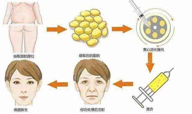 自体脂肪面部填充示意图 自体脂肪面部填充示意图