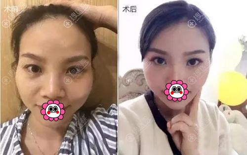 自体脂肪面部填充对比效果图 自体脂肪面部填充对比效果图