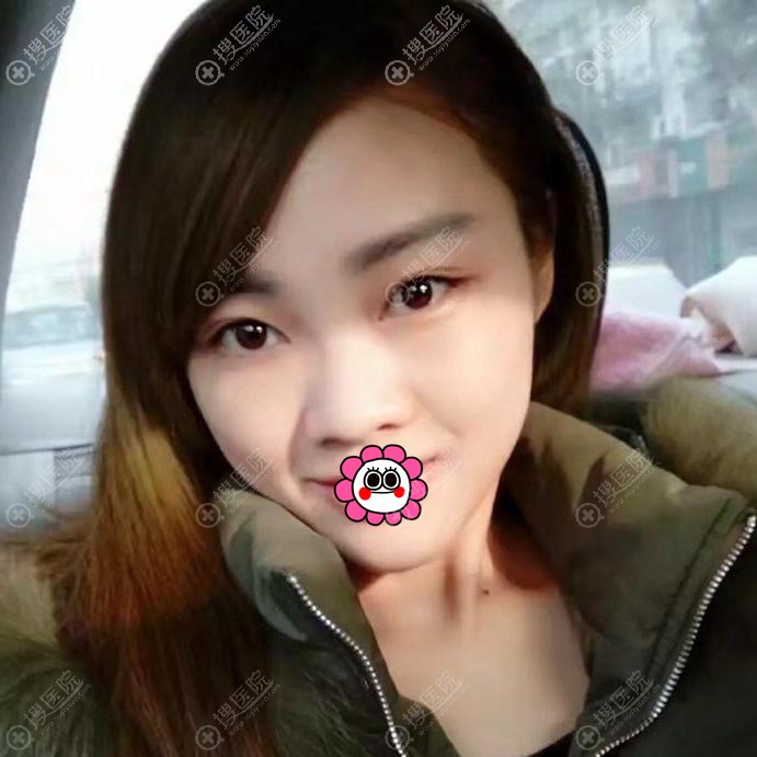 美女花费两万多元在郑州东方整形找黄军伟做的假体隆鼻案例