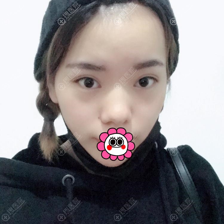 长沙雅美田芳斌膨体隆鼻案例:恢复三个月鼻子越来越好看