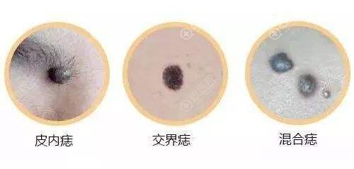 脸上有斑大都选择激光治疗,那么脸上的色素痣用激光可以去除吗