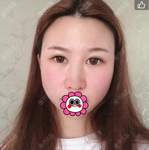 玻尿酸隆鼻变宽了,花三万多找太原时光张国军做硅胶隆鼻还不错