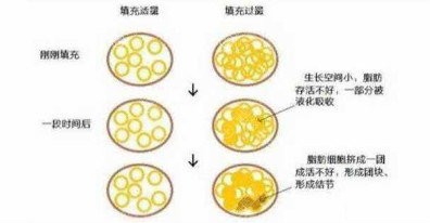 面部脂肪填充过多怎么办? 面部脂肪填充过多怎么办?