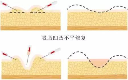 脂肪填充失败如何修复? 脂肪填充失败如何修复?