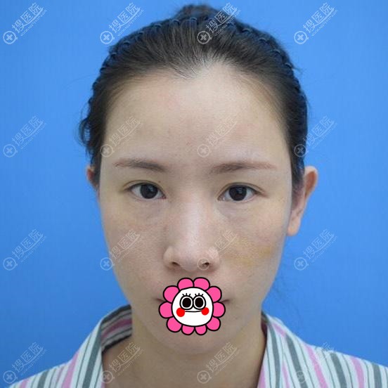 ������֬���沿���ǰ