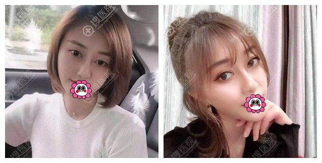 北京画美任召磊双眼皮对比效果 北京画美任召磊双眼皮对比效果