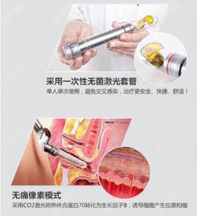 云南华美激光紧缩阴道优势 云南华美激光紧缩阴道优势