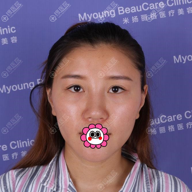 昆山米扬丽格张金辉做鼻子咋样?这里有他做的假体隆鼻作参考