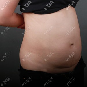 到西安高一生做腰腹吸脂前 到西安高一生做腰腹吸脂前