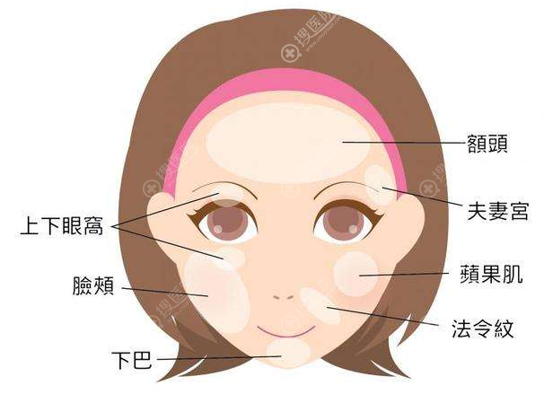 面部脂肪填充部位 面部脂肪填充部位