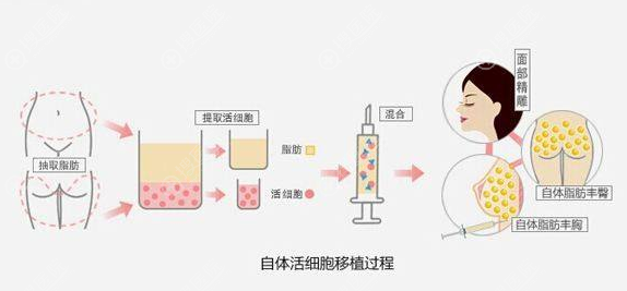 脂肪填充过程示意图 脂肪填充过程示意图