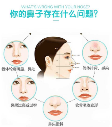 二次做鼻修复是选择肋骨隆鼻好还是耳软骨隆鼻好?