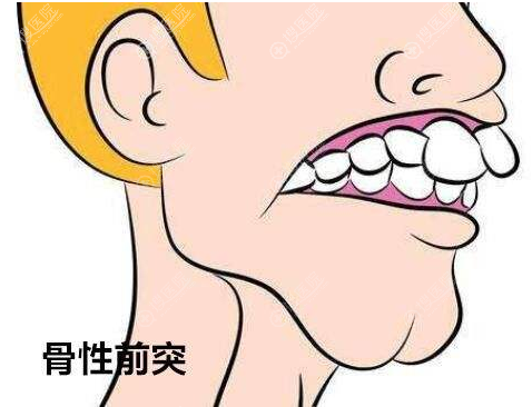 骨性龅牙怎么矫正?做正颌手术会出现皮肤松弛牙齿松动的风险吗