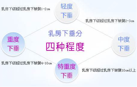 胸下垂做乳房悬吊手术多少钱?术后多久恢复会不会留疤