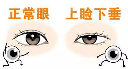 什么年龄做上睑下垂矫正手术比较好?不同年龄段矫正方法也不同