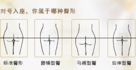 自体脂肪丰臀会不会下垂,是不是用假体丰臀效果更好一些