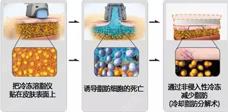 酷塑冷冻溶脂原理图 酷塑冷冻溶脂原理图