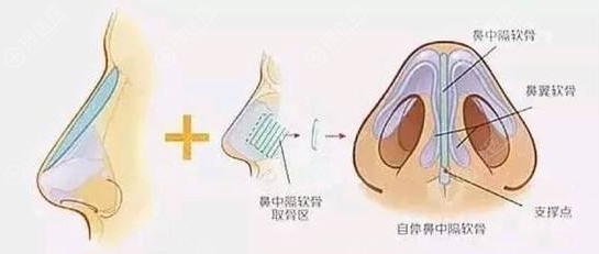 肋软骨隆鼻鼻尖发白是失败了吗 肋软骨隆鼻鼻尖发白是失败了吗