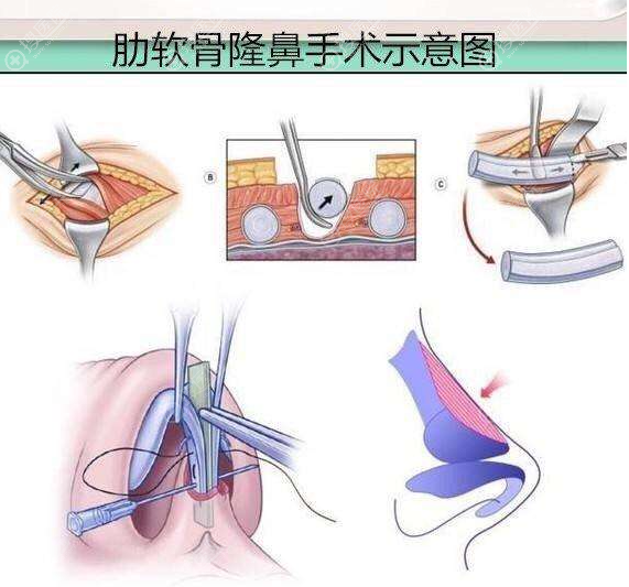 肋软骨隆鼻示意图 肋软骨隆鼻示意图