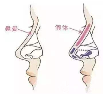 假体隆鼻出现排异现象,取出后还能再次做肋骨鼻吗?
