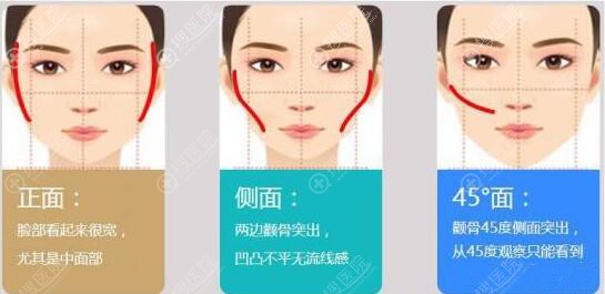颧骨针是什么原理,和王东一针降颧骨一样吗