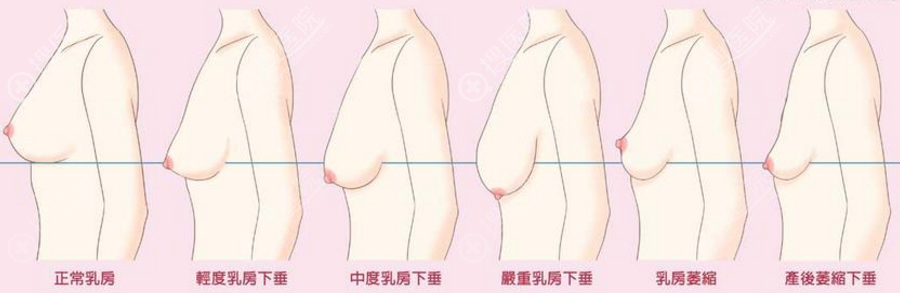 胸有点下垂适合做水滴假体比较自然,不推荐圆形假体哦