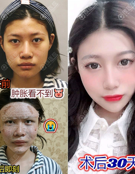 凸嘴导致法令纹加深怎么办?不想做正颌试试脂肪填充和注射吧