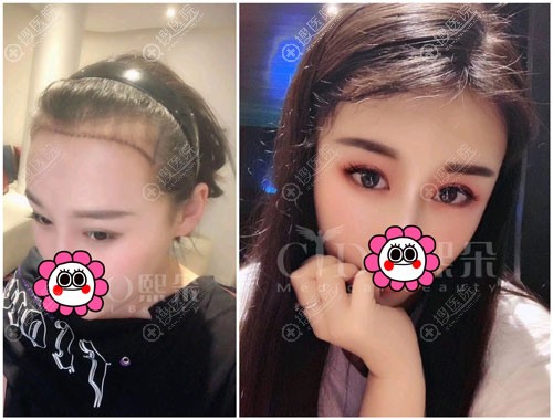 <!--<i data=20240710 data-id=12292></i>-->m型发际线种植案例 <!--<i data=20240710 data-id=12292></i>-->m型发际线种植案例