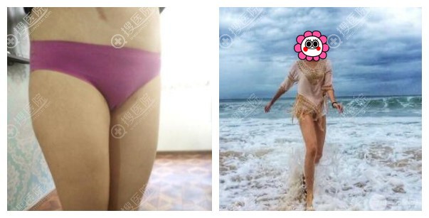 水动力吸脂瘦大腿对比效果 水动力吸脂瘦大腿对比效果