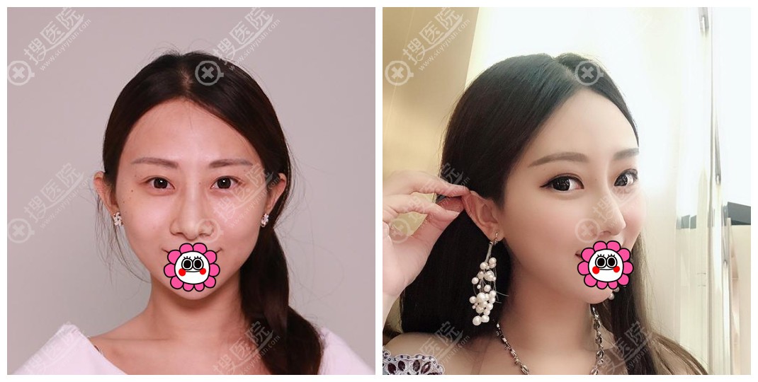 深圳鹏程鼻整形案例 深圳鹏程鼻整形案例