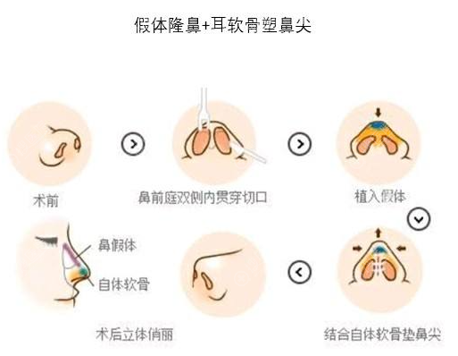 膨体+耳软骨隆鼻示意图 膨体+耳软骨隆鼻示意图