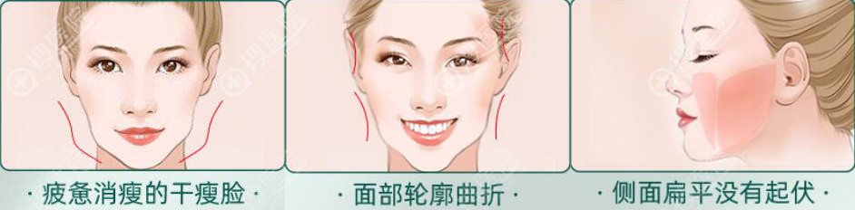 全脸脂肪胶填充需要多少钱?3万贵么?