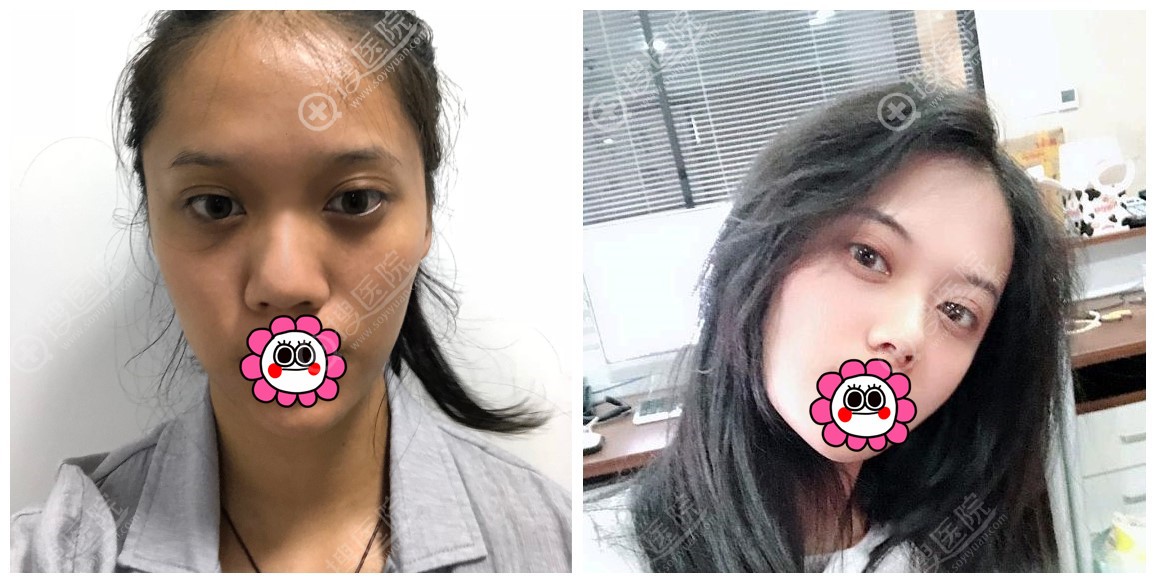 耳软骨隆鼻效果对比效果图 耳软骨隆鼻效果对比效果图